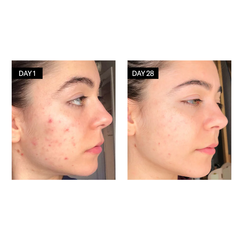 BL+C Pimples | Black Cumin + Cajeput Serum Concentrate