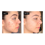 BL+C Pimples  Black Cumin + Cajeput Serum Concentrate