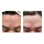 BL+C Pimples | Black Cumin + Cajeput Serum Concentrate