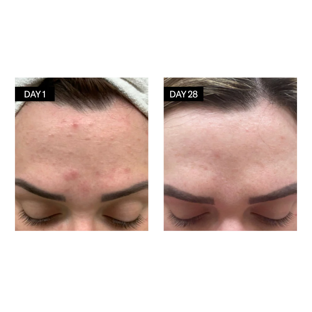 BL+C Pimples | Black Cumin + Cajeput Serum Concentrate