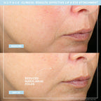 NuFACE® TRINITY+ Effective Lip & Eye Attachment