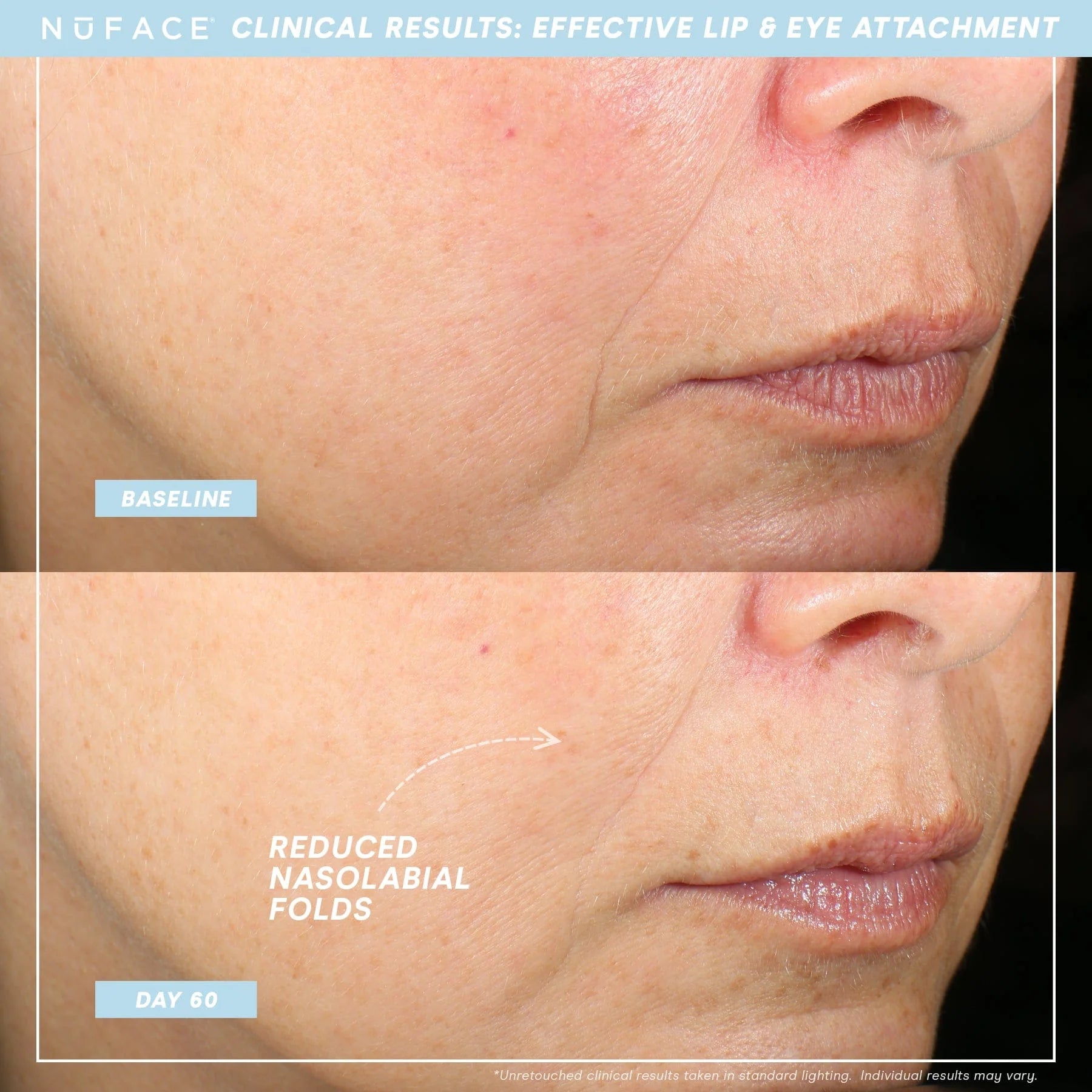 NuFACE® TRINITY+ Effective Lip & Eye Attachment